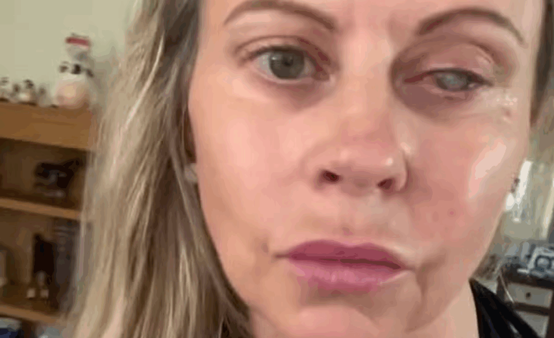 “Un parassita ha divorato il mio occhio, la cornea e tutti i miei nervi. E’ stato un dolore lancinante. I medici non riuscivano a credere alla velocità con cui ha agito”: la storia di Emma Marsden
