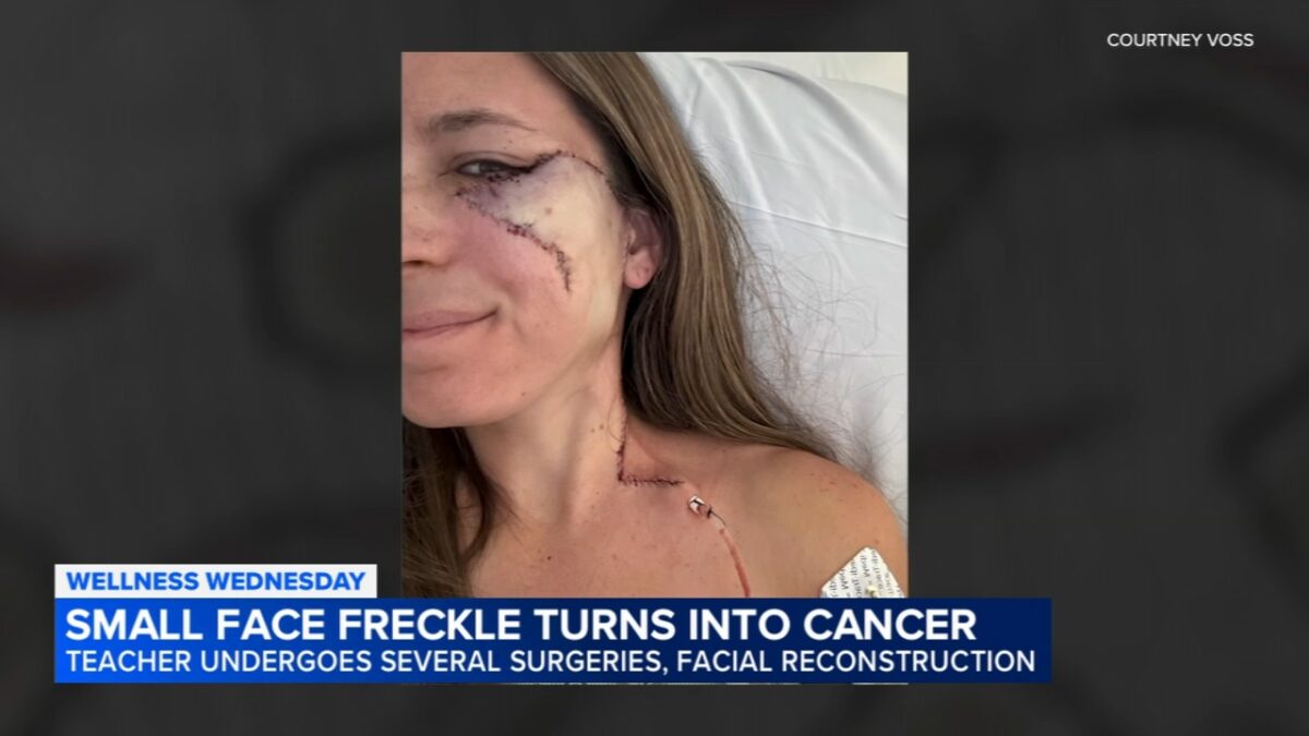 “Una lentiggine sul viso, poi la scoperta: era un melanoma. Il cancro alla pelle è una forma letale, fate prevenzione”: la storia di Courtney Voss