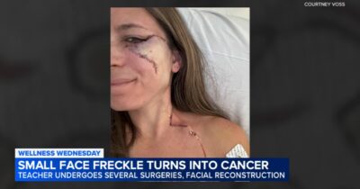 Copertina di “Una lentiggine sul viso, poi la scoperta: era un melanoma. Il cancro alla pelle è una forma letale, fate prevenzione”: la storia di Courtney Voss
