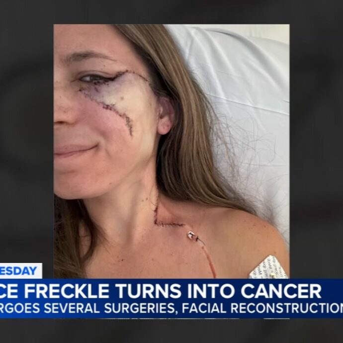 “Una lentiggine sul viso, poi la scoperta: era un melanoma. Il cancro alla pelle è una forma letale, fate prevenzione”: la storia di Courtney Voss
