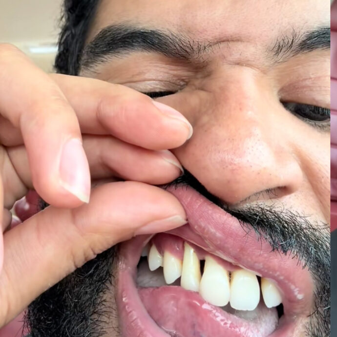 “A 25 anni mi sono caduti tutti i denti. Non sorridevo, non parlavo e non volevo baciare la mia fidanzata. È stato devastante”: la storia di Jonathan Peralta Jr