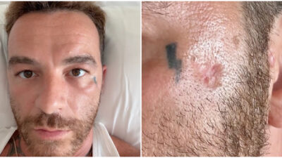 Copertina di “Purtroppo io, come tanti, ho messo le creme solari e il risultato è il cancro della pelle. Carcinoma basocellulare”: parla Salmo