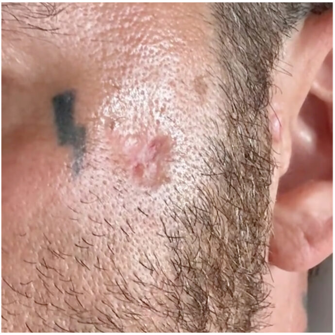 “Purtroppo io, come tanti, ho messo le creme solari e il risultato è il cancro della pelle. Carcinoma basocellulare”: parla Salmo