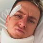 Copertina di La foto di Pogacar dall’ospedale dopo la caduta: deve operarsi, stagione a rischio. Come sta