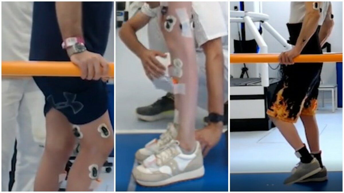 Quattro pazienti con lesione midollare camminano grazie al movimento del tronco e alla neurostimolazione