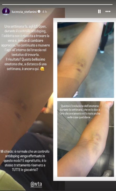 Us Open, Stefanini mostra un livido sul braccio: “Colpa di un controllo antidoping, non trovavano la vena e muovevano l’ago. Stesso trattamento per tutte?”