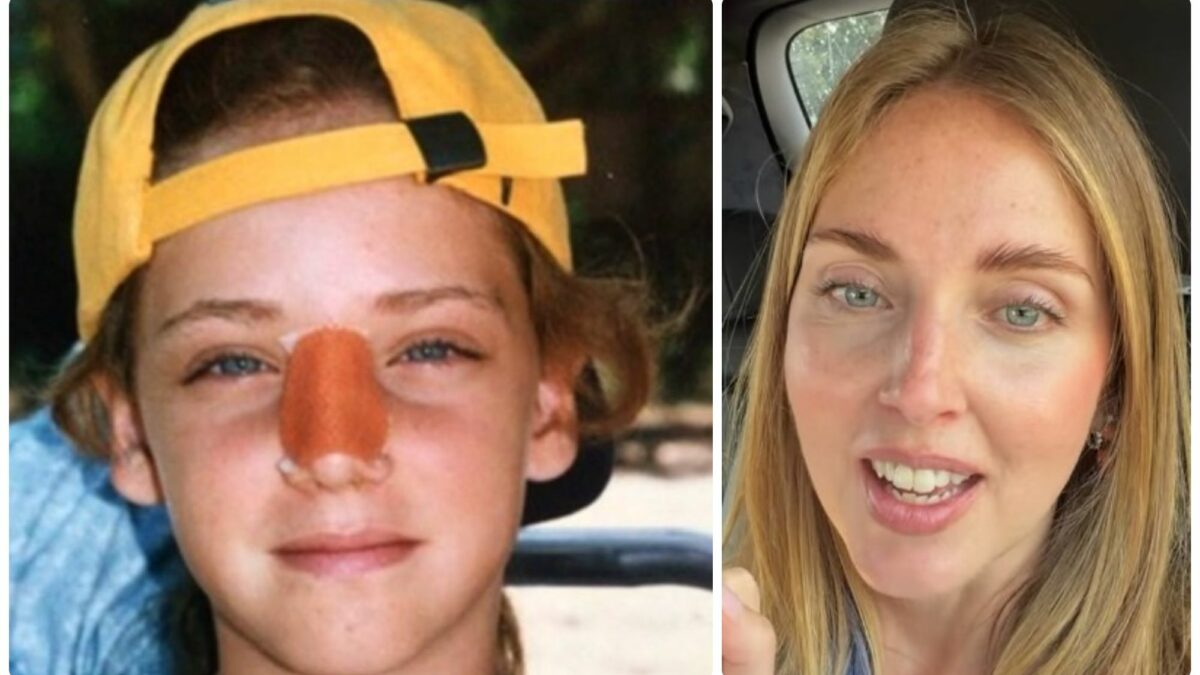 mi sono data una ginocchiata facendo bodysurf e il mio naso era tutto storto mio pap224 me lo ha subito girato ma me lo sono dovuto operare l236 alle hawaii chiara ferragni racconta l8217incidente avuto a 10 anni da Ilfattoquotidiano.it mi sono data una ginocchiata facendo bodysurf e il mio naso era tutto storto mio pap224 me lo ha subito girato ma me lo sono dovuto operare l236 alle hawaii chiara ferragni racconta l8217incidente avuto a 10 anni