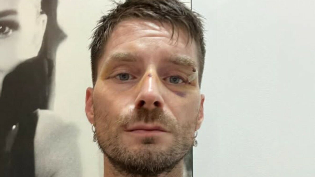 “Mi hanno dato una ventina di pugni in faccia. Sento ancora il sapore del sangue in bocca”: il racconto del direttore di Novella 2000 aggredito a Milano
