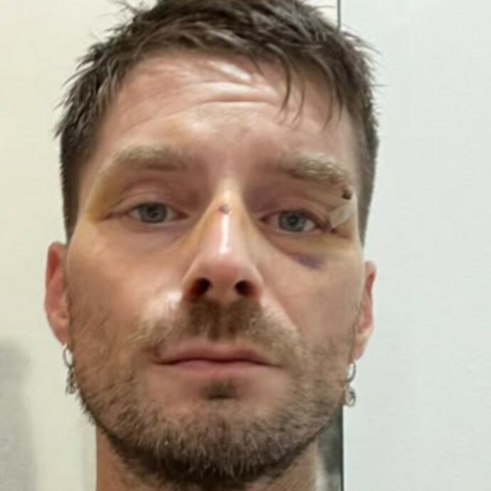 “Mi hanno dato una ventina di pugni in faccia. Sento ancora il sapore del sangue in bocca”: il racconto del direttore di Novella 2000 aggredito a Milano