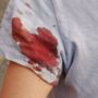 Copertina di Donna ferita al braccio da un colpo ad aria compressa in strada in zona Prati (Roma), il racconto sui social. “Segnalazioni di altri episodi contro donne e turiste”