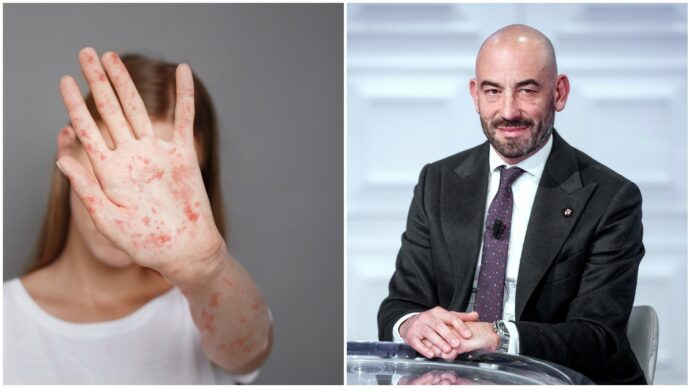 “Siamo solo all’inizio di una gravissima epidemia”: Matteo Bassetti lancia l’allarme dopo il boom di casi di morbillo in Italia