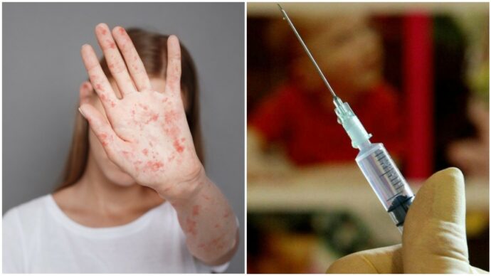 “Ridurre le vaccinazioni contro il morbillo può aprire la strada a epidemie molto estese”, l’infettivologo e lo studio Usa sul rischio di decessi pediatrici