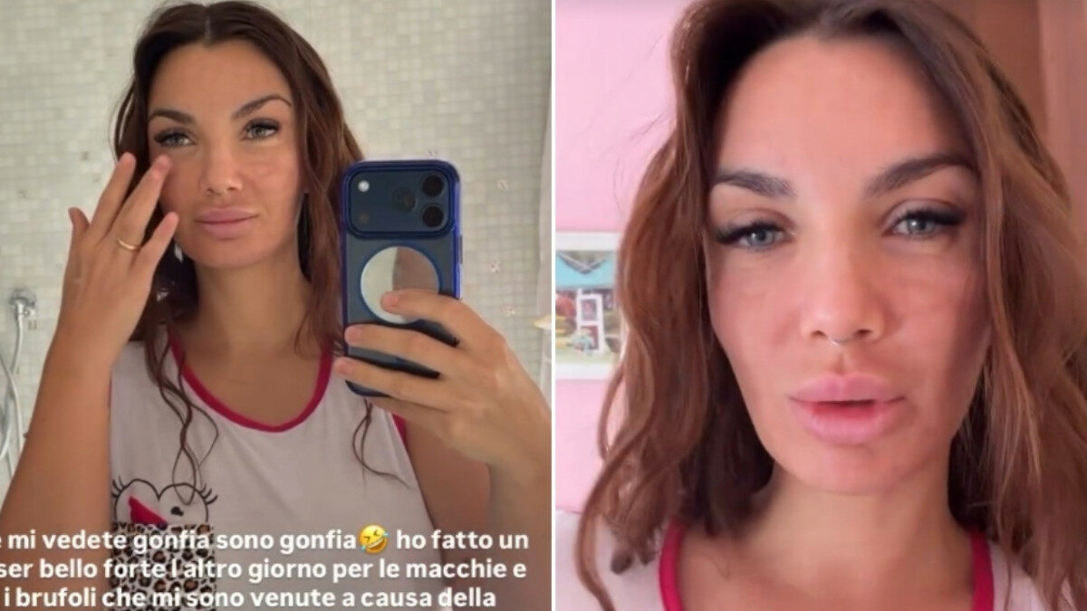“Se mi vedete gonfia, sono gonfia. Ho fatto un laser bello forte per le macchie e i brufoli che mi sono venuti con la pillola anticoncezionale”: Elettra Lamborghini racconta la sua esperienza