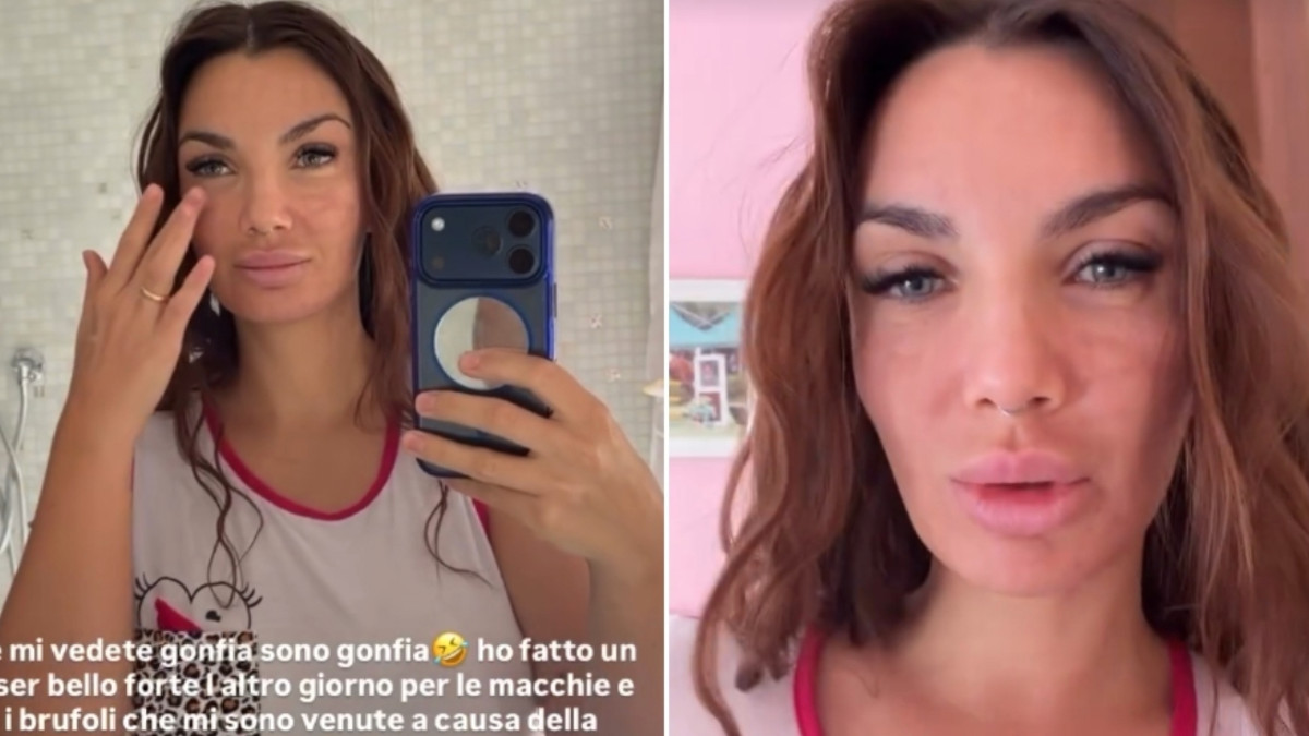 se mi vedete gonfia sono gonfia ho fatto un laser bello forte per le macchie e i brufoli che mi sono venuti con la pillola anticoncezionale elettra lamborghini racconta la sua esperienza da Ilfattoquotidiano.it se mi vedete gonfia sono gonfia ho fatto un laser bello forte per le macchie e i brufoli che mi sono venuti con la pillola anticoncezionale elettra lamborghini racconta la sua esperienza